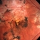 Serpiginous Choroiditis Serpiginous Choroiditis